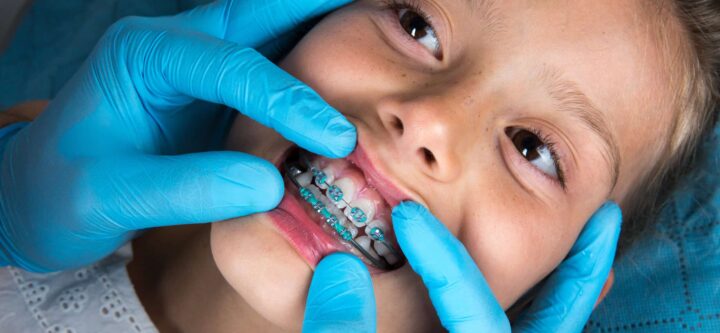 Dentist, Orthodontist examining a little girl patient's teeth with green braces. Close up of girl head and dentist, orthodontist hands with blue gloves