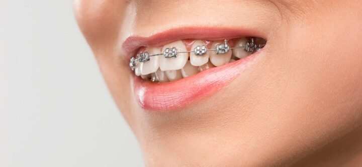 beautiful-young-woman-with-teeth-braces_155003-1047