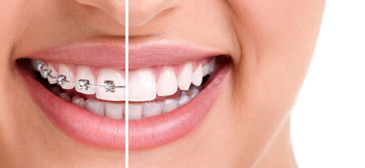braces-aesthetics