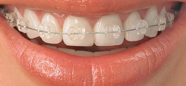 ceramic-braces2