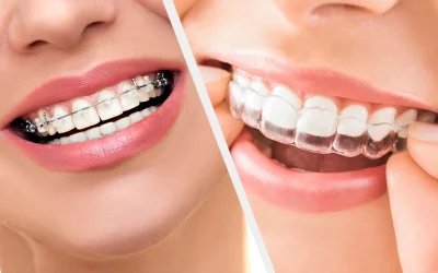 Clear-Aligners-Better-Than-Ceramic-Braces_dbe287c3-3efd-4679-84d1-3852a6a7f38e